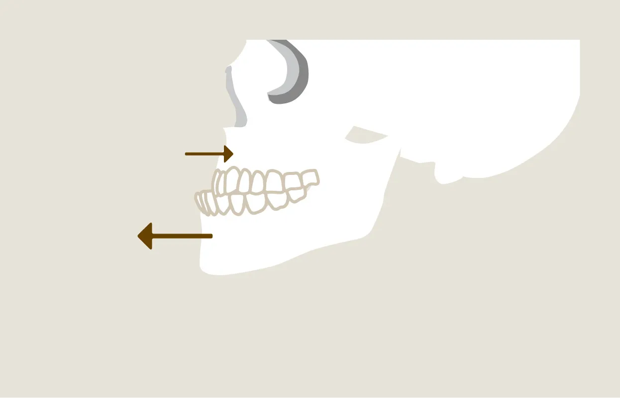 下顎前突（受け口）の原因 