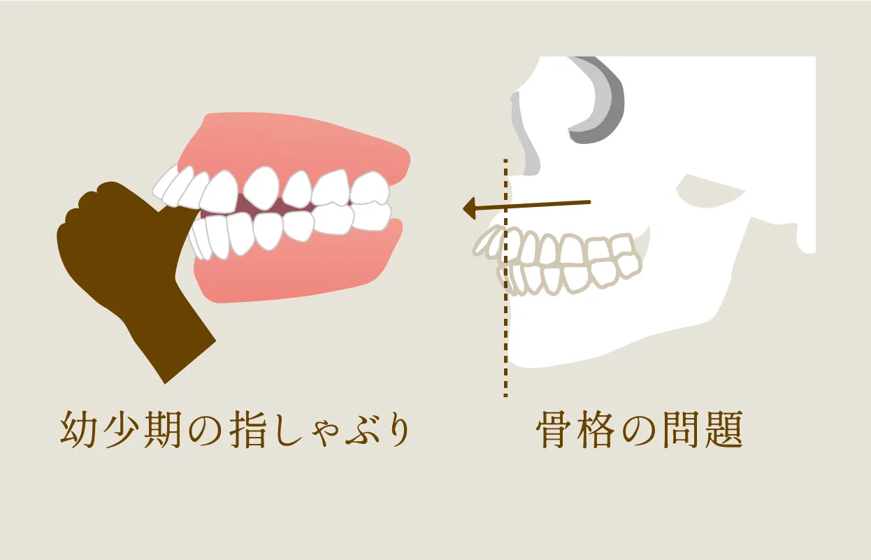 上顎前突（出っ歯）の原因 